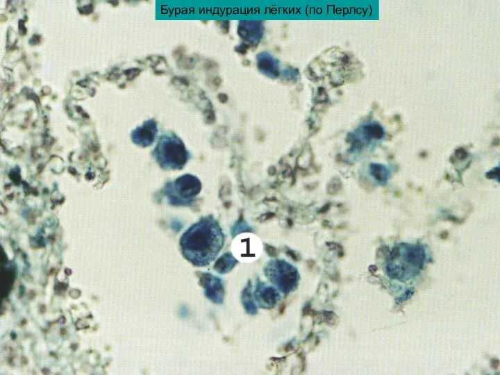 Бурая индурация лёгких (по Перлсу)