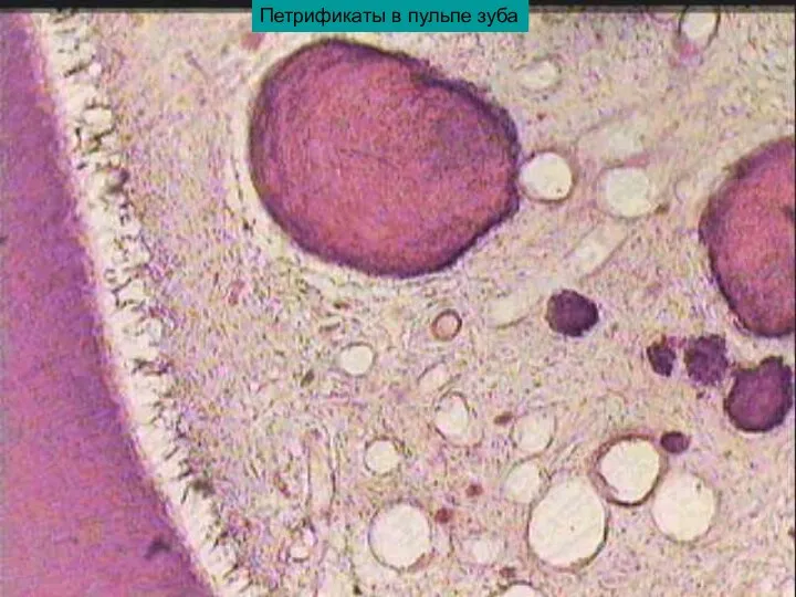 Петрификаты в пульпе зуба