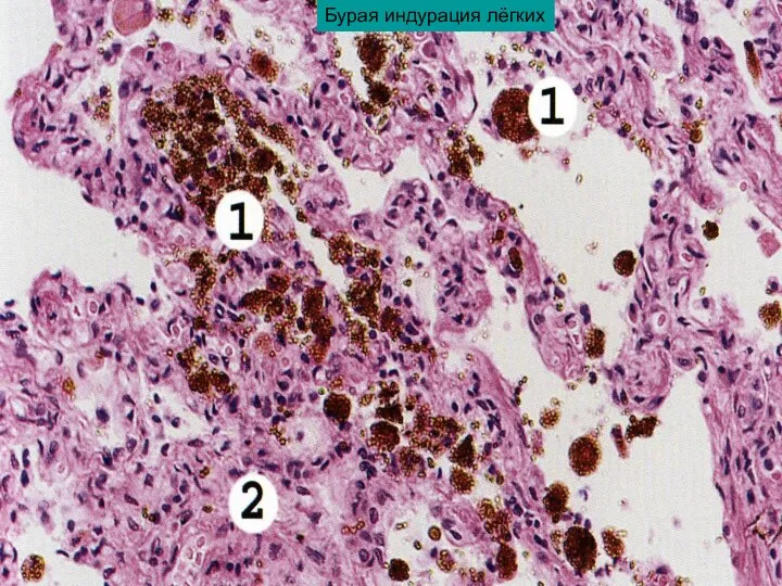Бурая индурация лёгких