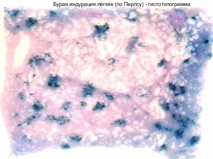 Бурая индурация лёгких (по Перлсу) - гистотопограмма