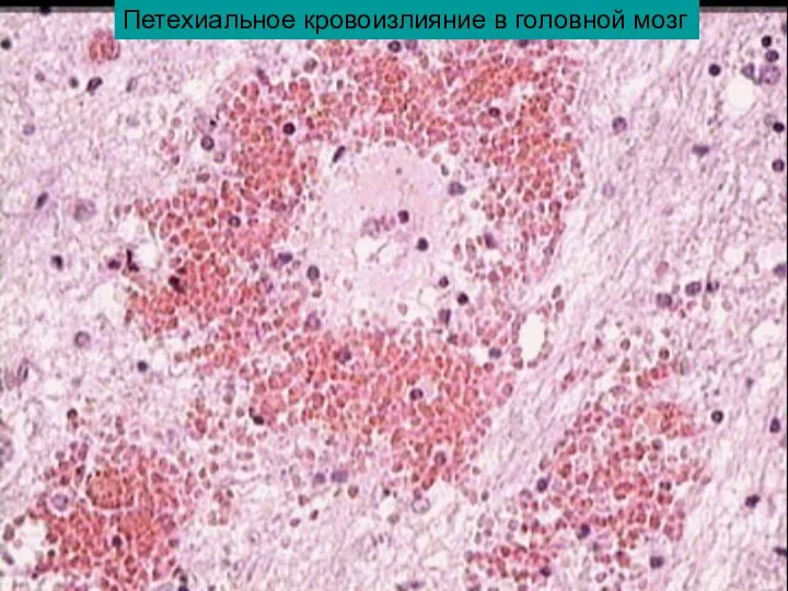 Петехиальное кровоизлияние в головной мозг