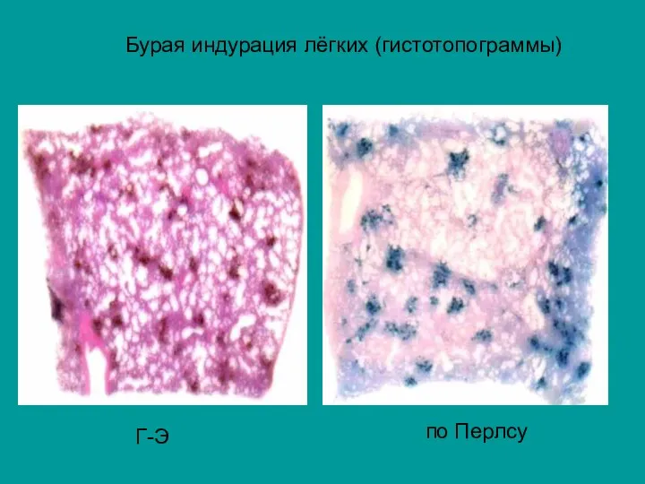 Бурая индурация лёгких (гистотопограммы) Г-Э по Перлсу