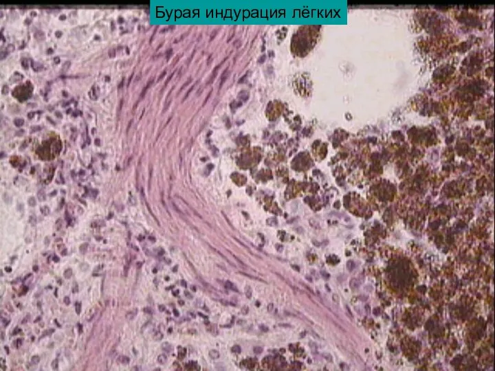 Бурая индурация лёгких