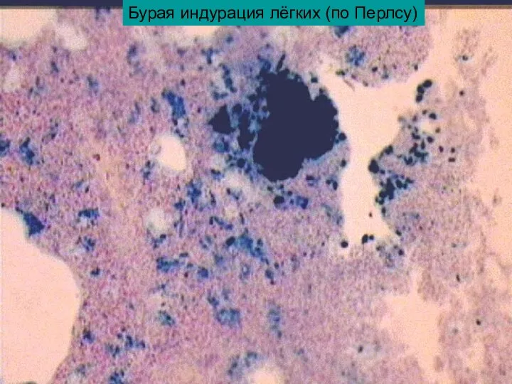 Бурая индурация лёгких (по Перлсу)