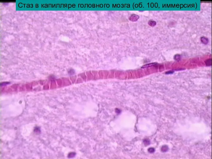 Стаз в капилляре головного мозга (об. 100, иммерсия)