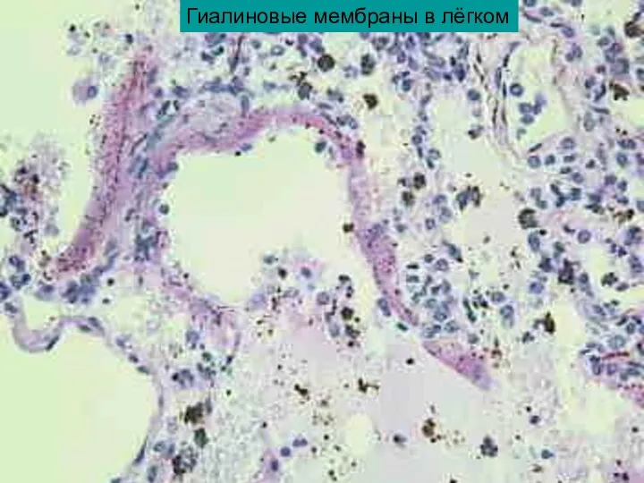 Гиалиновые мембраны в лёгком