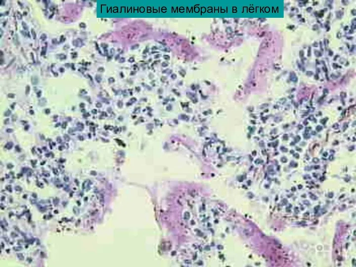 Гиалиновые мембраны в лёгком