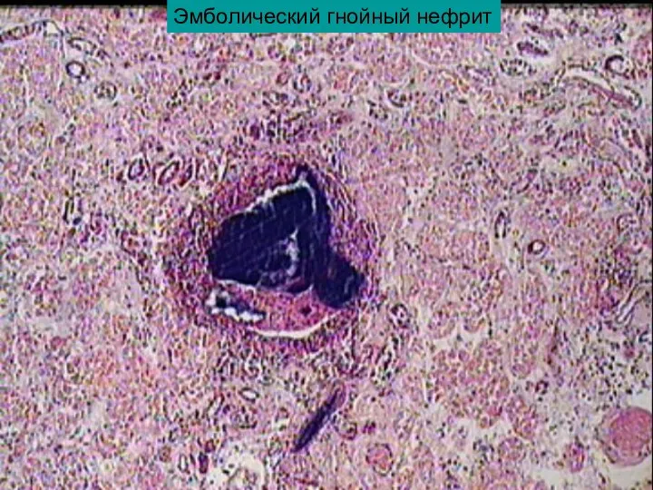 Эмболический гнойный нефрит