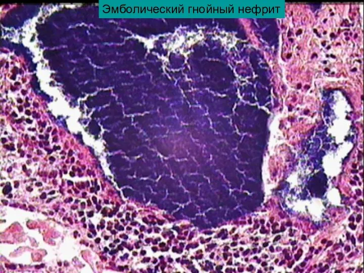 Эмболический гнойный нефрит