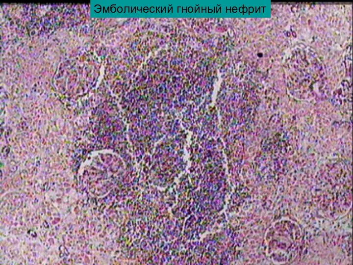 Эмболический гнойный нефрит