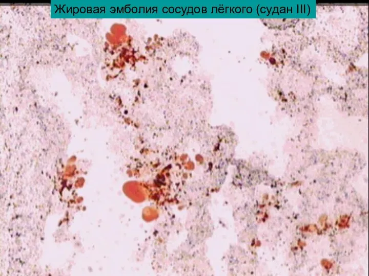 Жировая эмболия сосудов лёгкого (судан III)
