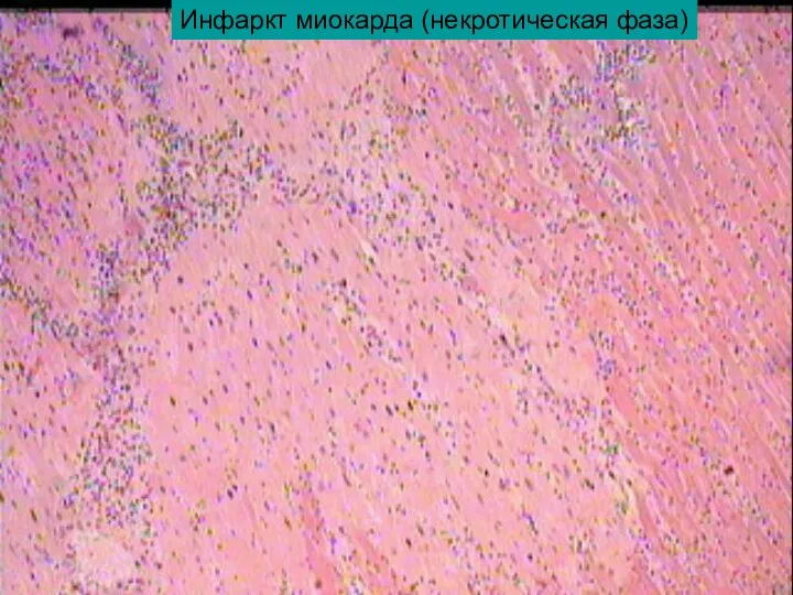 Инфаркт миокарда (некротическая фаза)