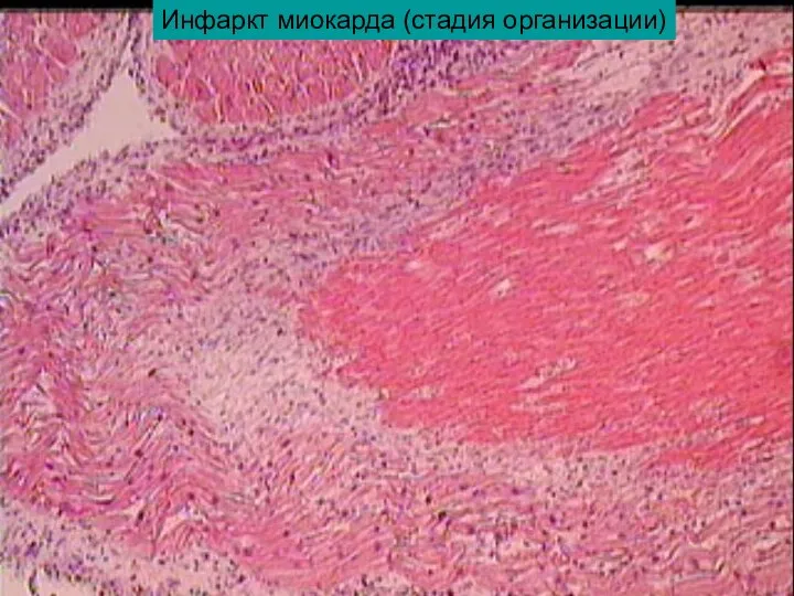 Инфаркт миокарда (стадия организации)