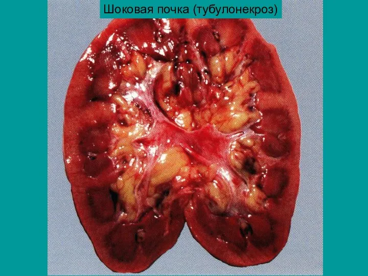 Шоковая почка (тубулонекроз)