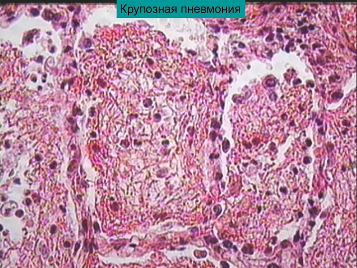 Крупозная пневмония