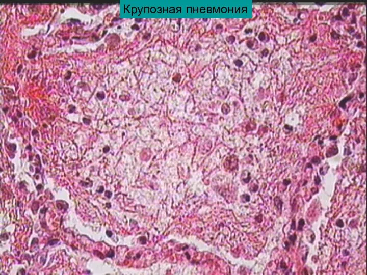 Крупозная пневмония