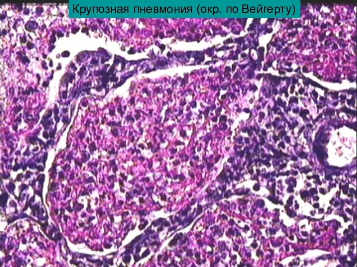 Крупозная пневмония (окр. по Вейгерту)