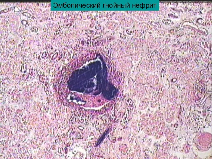 Эмболический гнойный нефрит