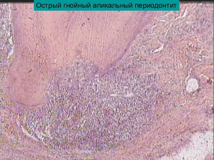 Острый гнойный апикальный периодонтит