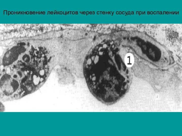 Проникновение лейкоцитов через стенку сосуда при воспалении