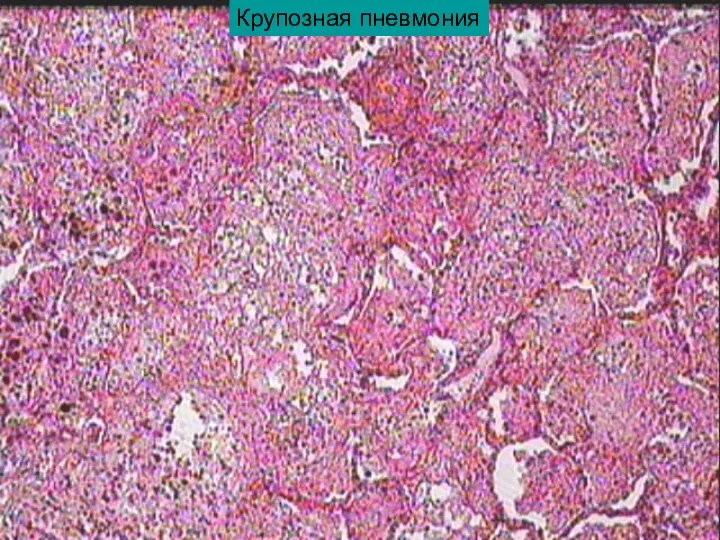 Крупозная пневмония