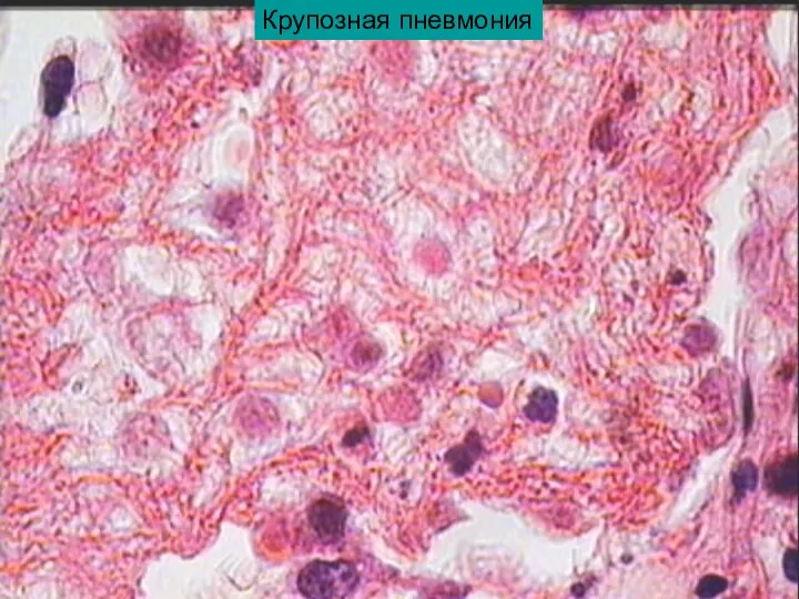 Крупозная пневмония