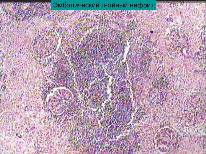 Эмболический гнойный нефрит