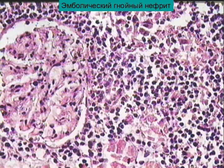 Эмболический гнойный нефрит