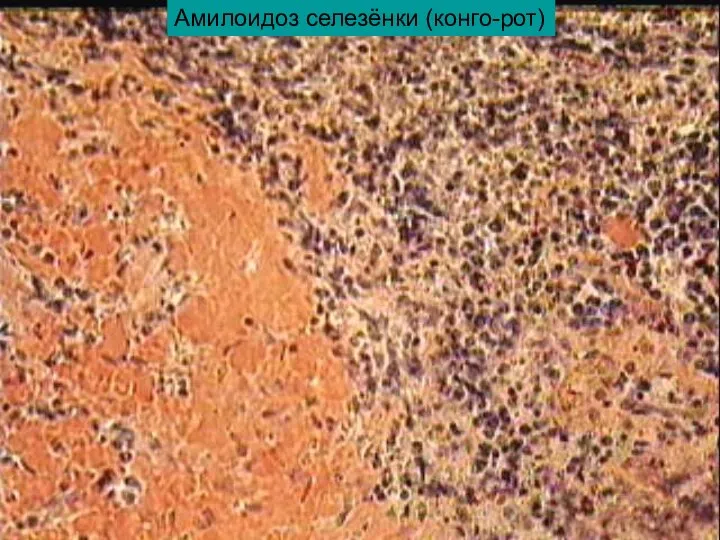 Амилоидоз селезёнки (конго-рот)