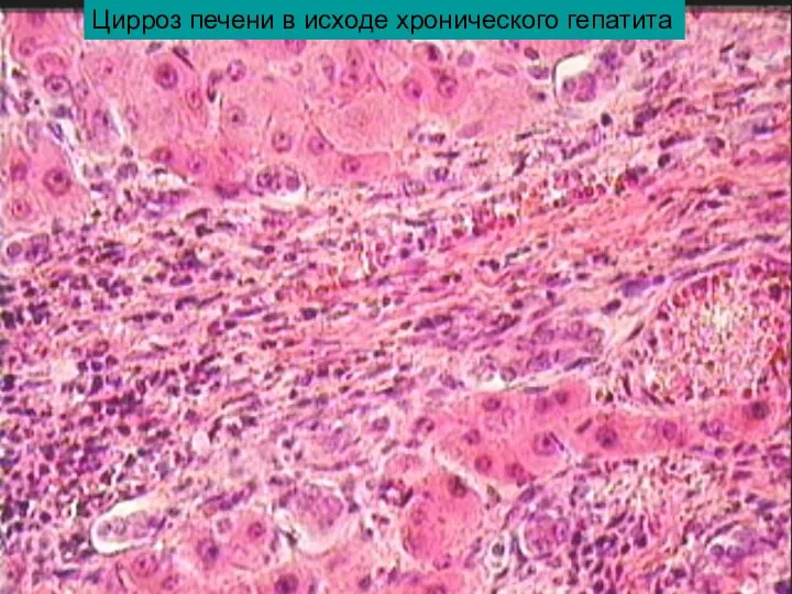 Цирроз печени в исходе хронического гепатита