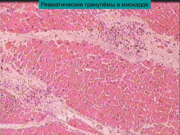Ревматические гранулёмы в миокарде