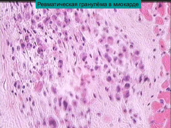 Ревматическая гранулёма в миокарде