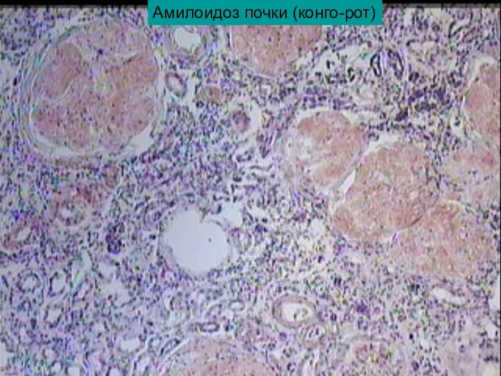 Амилоидоз почки (конго-рот)