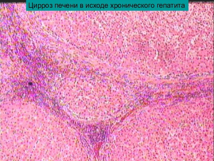 Цирроз печени в исходе хронического гепатита