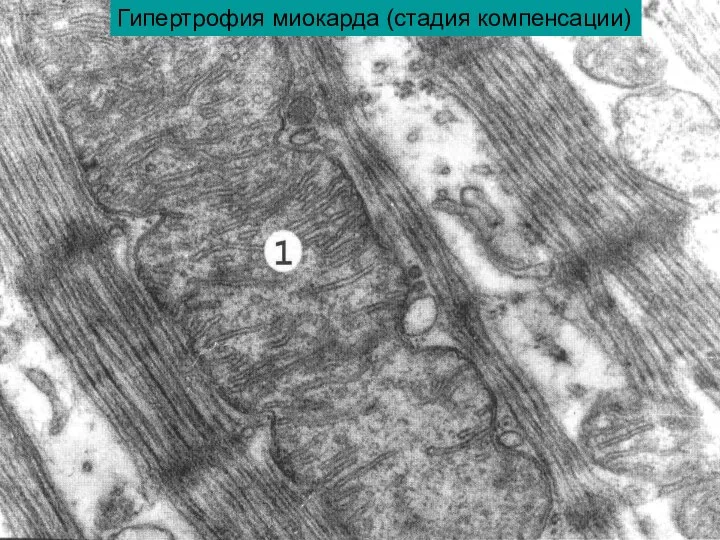 Гипертрофия миокарда (стадия компенсации)