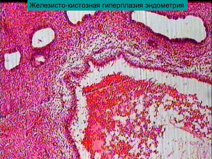 Железисто-кистозная гиперплазия эндометрия