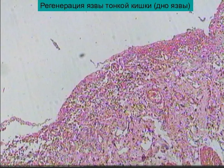 Регенерация язвы тонкой кишки (дно язвы)