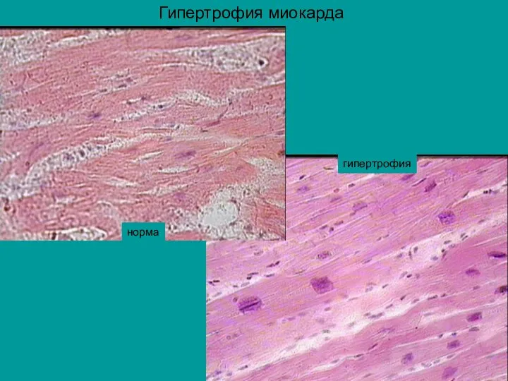 норма гипертрофия Гипертрофия миокарда