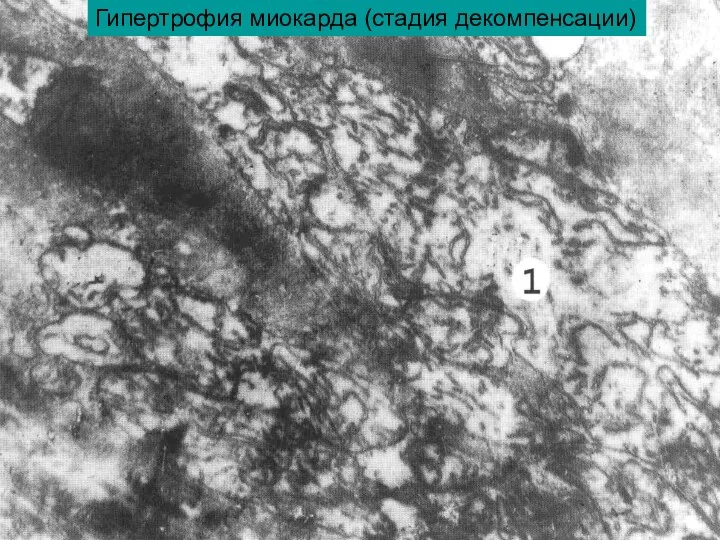 Гипертрофия миокарда (стадия декомпенсации)