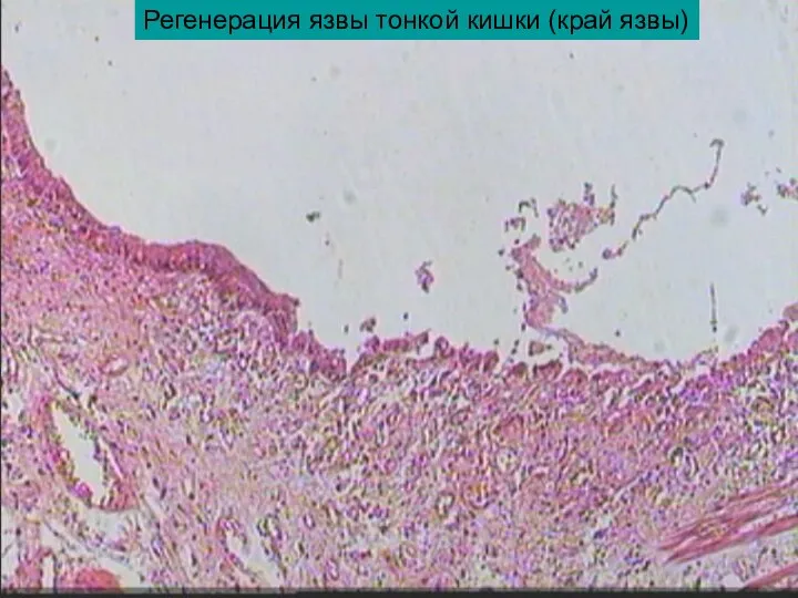 Регенерация язвы тонкой кишки (край язвы)