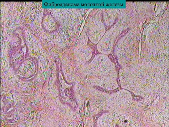 Фиброаденома молочной железы