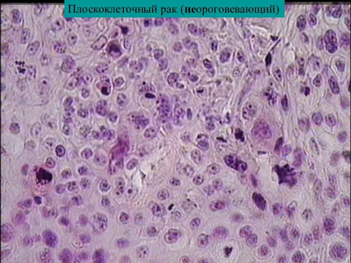 Плоскоклеточный рак (неороговевающий)