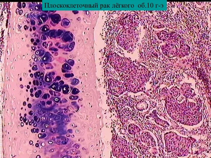 Плоскоклеточный рак лёгкого об.10 г-э