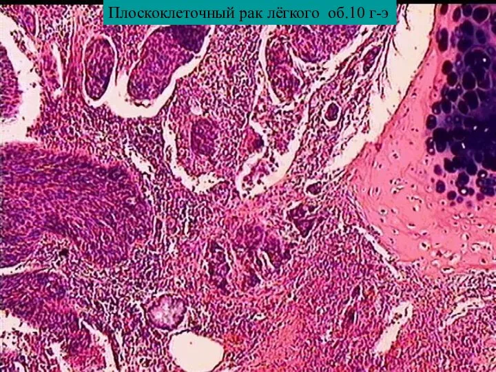 Плоскоклеточный рак лёгкого об.10 г-э