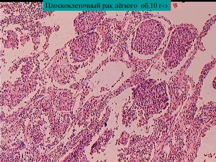 Плоскоклеточный рак лёгкого об.10 г-э