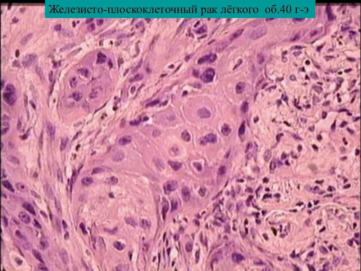 Железисто-плоскоклеточный рак лёгкого об.40 г-э