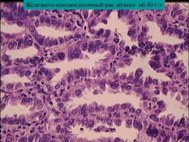 Железисто-плоскоклеточный рак лёгкого об.40 г-э