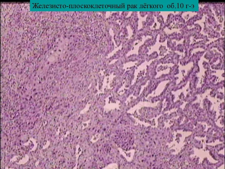 Железисто-плоскоклеточный рак лёгкого об.10 г-э