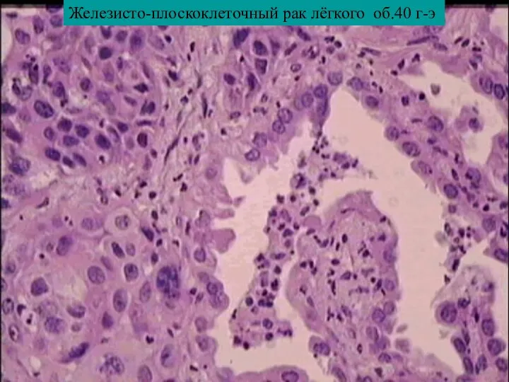 Железисто-плоскоклеточный рак лёгкого об.40 г-э