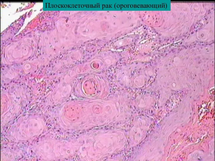 Плоскоклеточный рак (ороговевающий)
